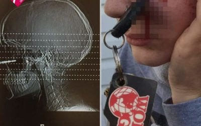 INSÓLITO ACCIDENTE: A UNA CHICA SE LE INCRUSTAN LAS LLAVES EN SU ROSTRO